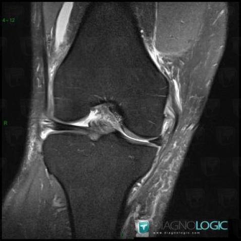 Medial collateral ligament rupture, Medial collateral ligament - Knee, MRI