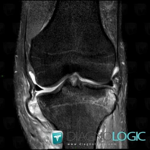 Medial collateral ligament rupture, Medial collateral ligament - Knee, MRI