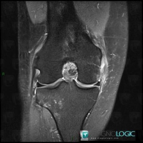 Radiology case : Medial collateral ligament rupture (MRI) - Diagnologic