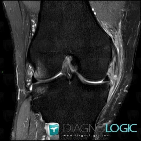 Radiology case : Medial collateral ligament rupture (MRI) - Diagnologic