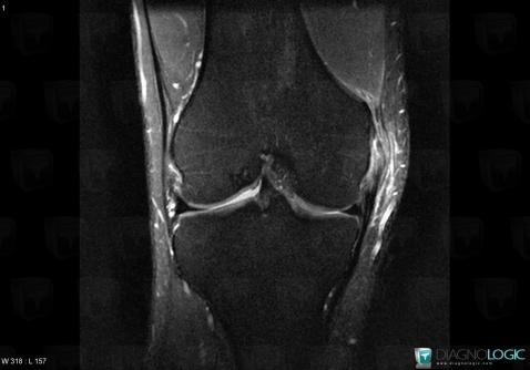 Medial collateral ligament rupture, Medial collateral ligament - Knee, MRI