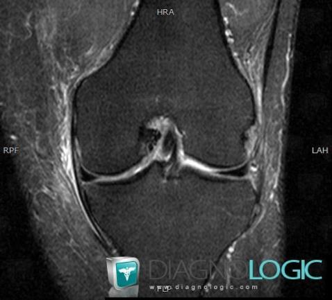 Medial collateral ligament rupture, Medial collateral ligament - Knee, MRI