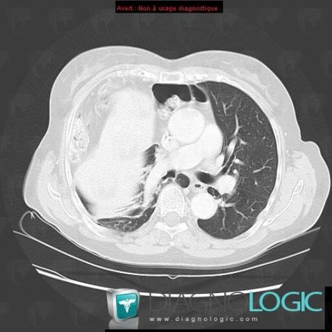 Mediastinum, CT