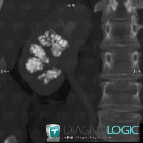 Medullary sponge kidney, Kidney, CT