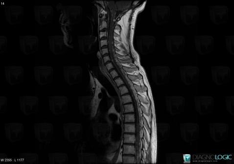 Medulloblastoma, Spinal canal / Cord, MRI