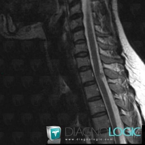 Medulloblastoma, Spinal canal / Cord, MRI