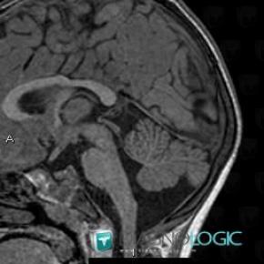 Mega cisterna magna, Posterior fossa, MRI