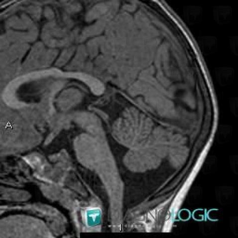 Mega cisterna magna, Posterior fossa, MRI