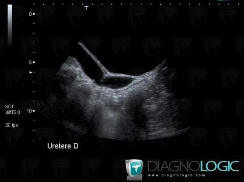 Méga uretère, Uretère, Echographie