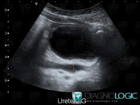 Méga uretère, Uretère, Echographie