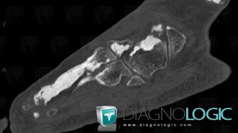 Melorheostosis, Cuboid, CT