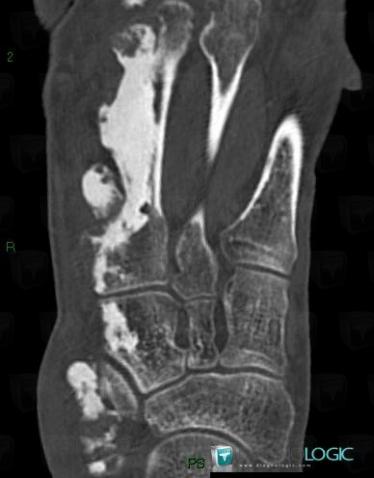 Melorheostosis, Cuneiforms bones, Metatarsal bones, CT