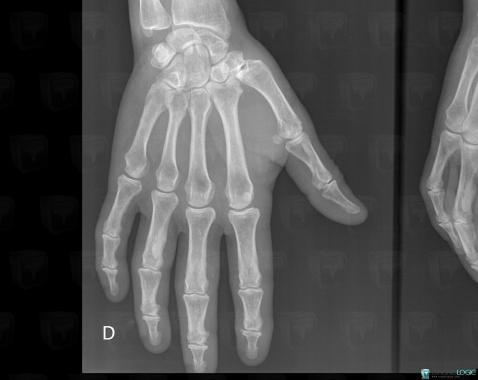 Melorheostosis, Phalanx / Sesamoid bones - Hand, X rays