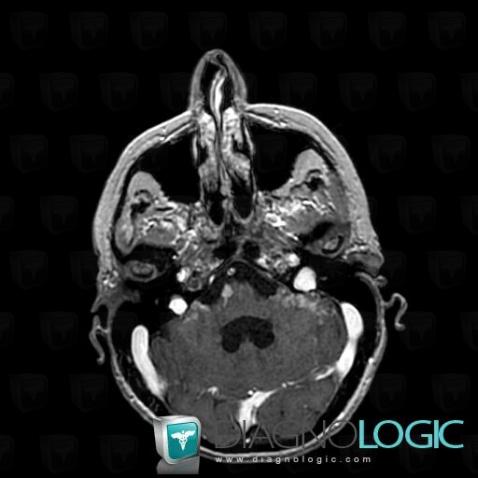 Meningeal carcinomatosis, Infratentorial peri cerebral spaces, MRI