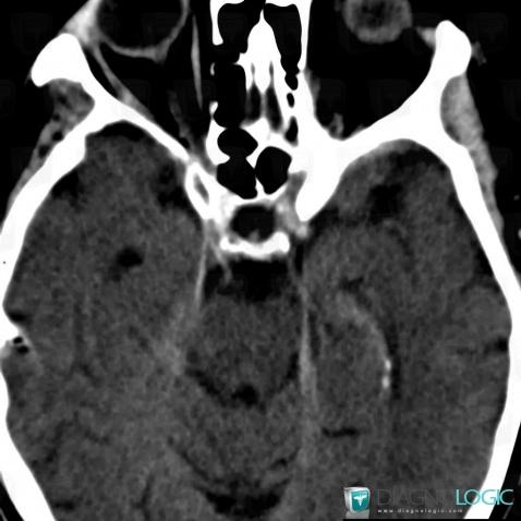 Meningeal carcinomatosis, Other cranial nerve, CT