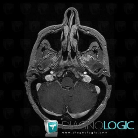 Meningeal carcinomatosis, Other cranial nerve, MRI