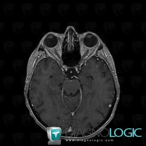 Meningeal carcinomatosis, Pituitary gland and parasellar region, MRI