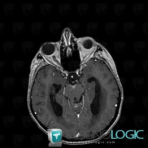 Meningeal carcinomatosis, Pituitary gland and parasellar region, MRI