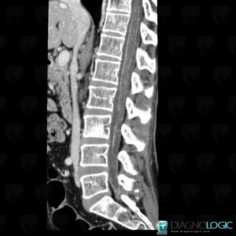 Meningeal carcinomatosis, Spinal canal / Cord, CT