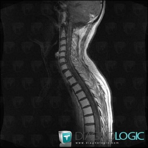 Meningeal carcinomatosis, Spinal canal / Cord, MRI