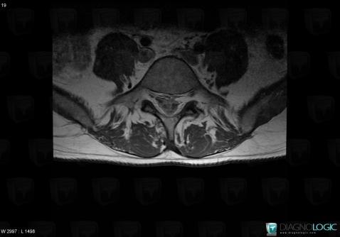 Meningeal carcinomatosis, Spinal canal / Cord, MRI