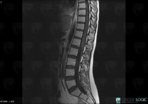 Meningeal carcinomatosis, Spinal canal / Cord, MRI