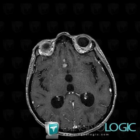 Meningeal carcinomatosis, Supratentorial peri cerebral spaces, MRI