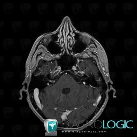 Meningeal carcinomatosis, VII VIII nerves, MRI