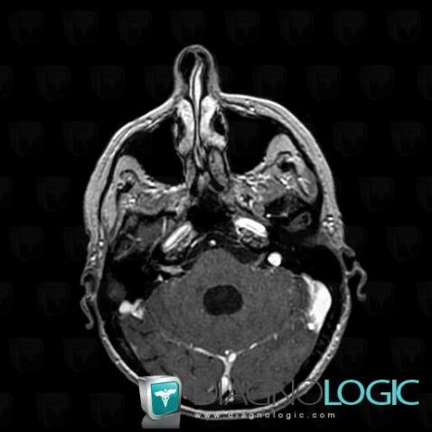 Meningeal carcinomatosis, VII VIII nerves, MRI