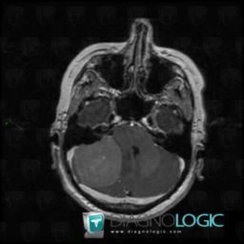 Meningioma, Cerebellopontine angle, Infratentorial peri cerebral spaces, MRI