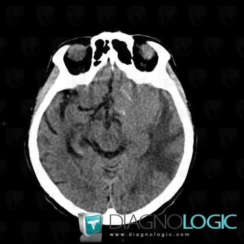 Meningioma, Cerebral hemispheres, CT