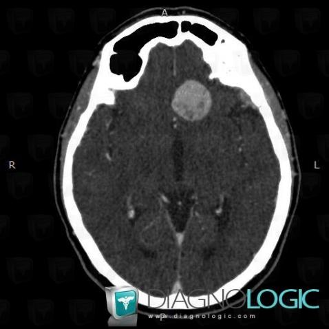 Meningioma, Cerebral hemispheres, CT