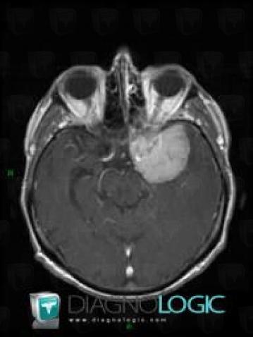 Meningioma, Cerebral hemispheres, MRI