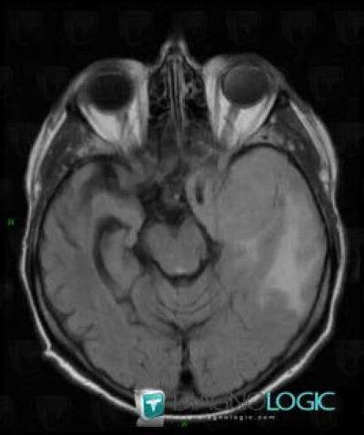 Meningioma, Cerebral hemispheres, MRI