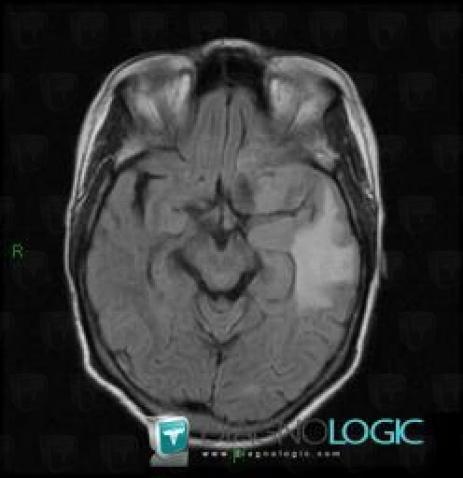 Meningioma, Cerebral hemispheres, MRI