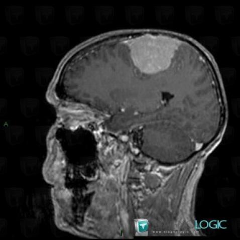 Meningioma, Cerebral hemispheres, MRI