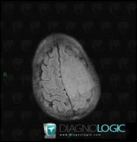 Meningioma, Cerebral hemispheres, MRI