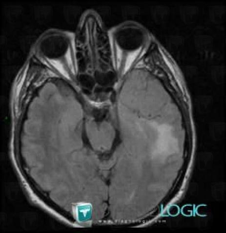 Meningioma, Cerebral hemispheres, MRI