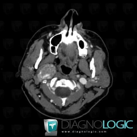 Meningioma, Deep facial spaces, CT