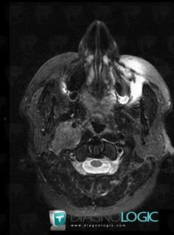 Meningioma, Deep facial spaces, MRI