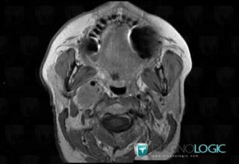 Meningioma, Deep facial spaces, MRI