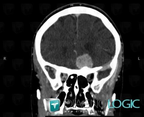 Meningioma, Eye, CT