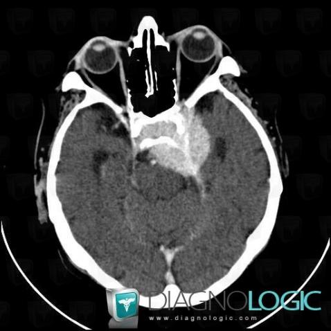 Meningioma, Infratentorial peri cerebral spaces, Pituitary gland and parasellar region, CT