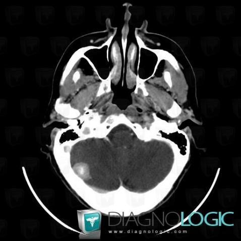 Meningioma, Infratentorial peri cerebral spaces, Posterior fossa, CT