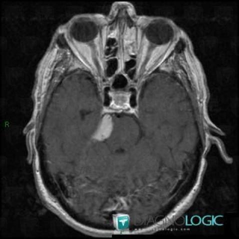 Meningioma, Infratentorial peri cerebral spaces, Posterior fossa, MRI
