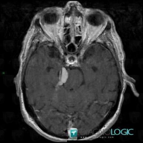 Meningioma, Infratentorial peri cerebral spaces, Posterior fossa, MRI