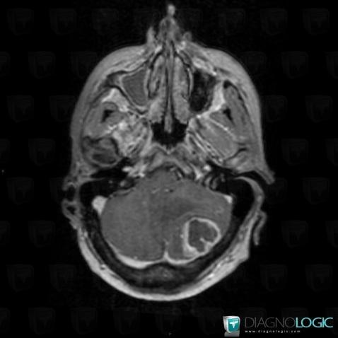 Meningioma, Infratentorial peri cerebral spaces, Posterior fossa, MRI
