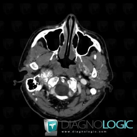 Meningioma, Jugular foramen, CT