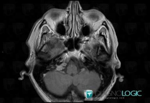 Meningioma, Jugular foramen, MRI