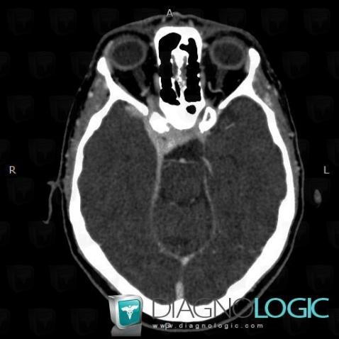 Meningioma, Optic nerve, CT